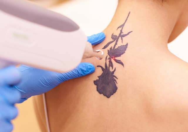 Tattoo Removal: Solution for Unwanted Ink